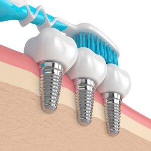 tips-to-prevent-dental-implant-failure