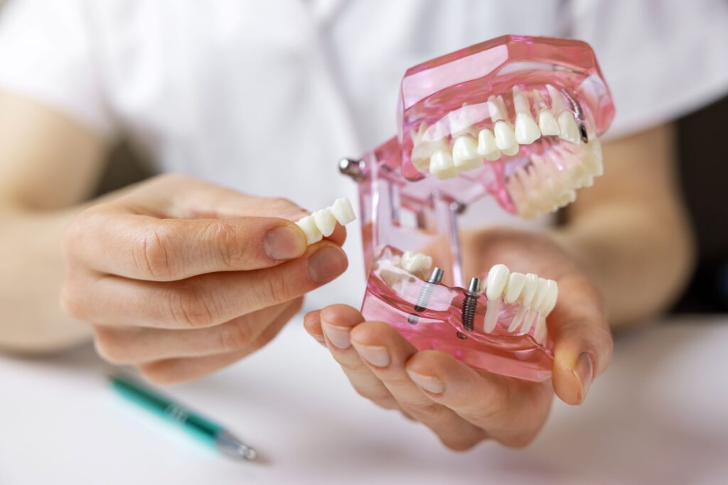 Dentist holding model jaw with two dental implants to support a bridge